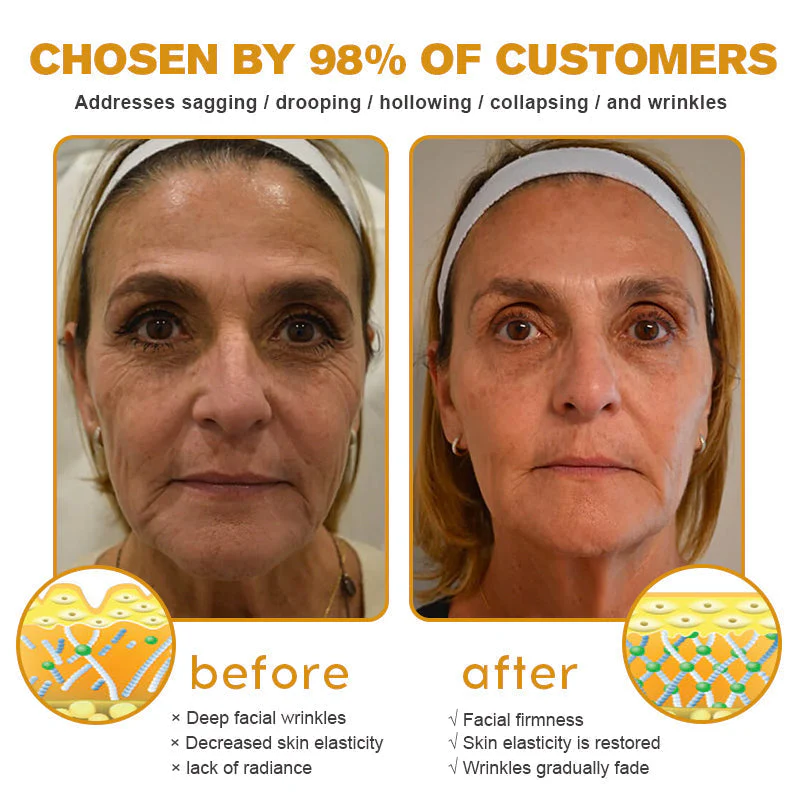 👨‍⚕️👨‍⚕️ Made and Shipped from US✅ Botox Bee Venom Wrinkle Removal Cream- LAST DAY 80% OFF